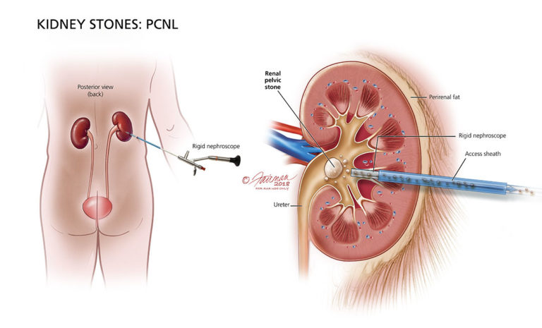 symptoms-of-a-stuck-kidney-stone-in-female-urethra-youtube