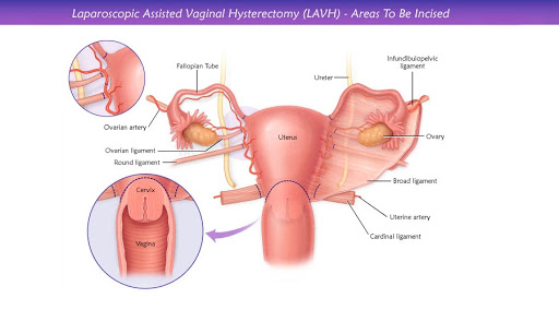 Vaginal hysterectomy ap repair