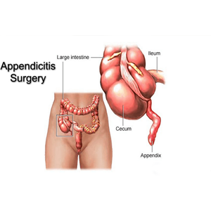 Appendix removal by laparoscopy
